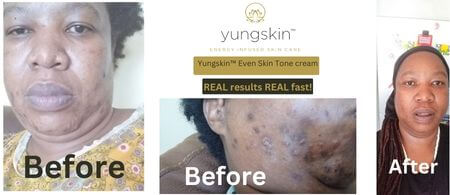 Yungskin™ Even Skin Tone cream Banner