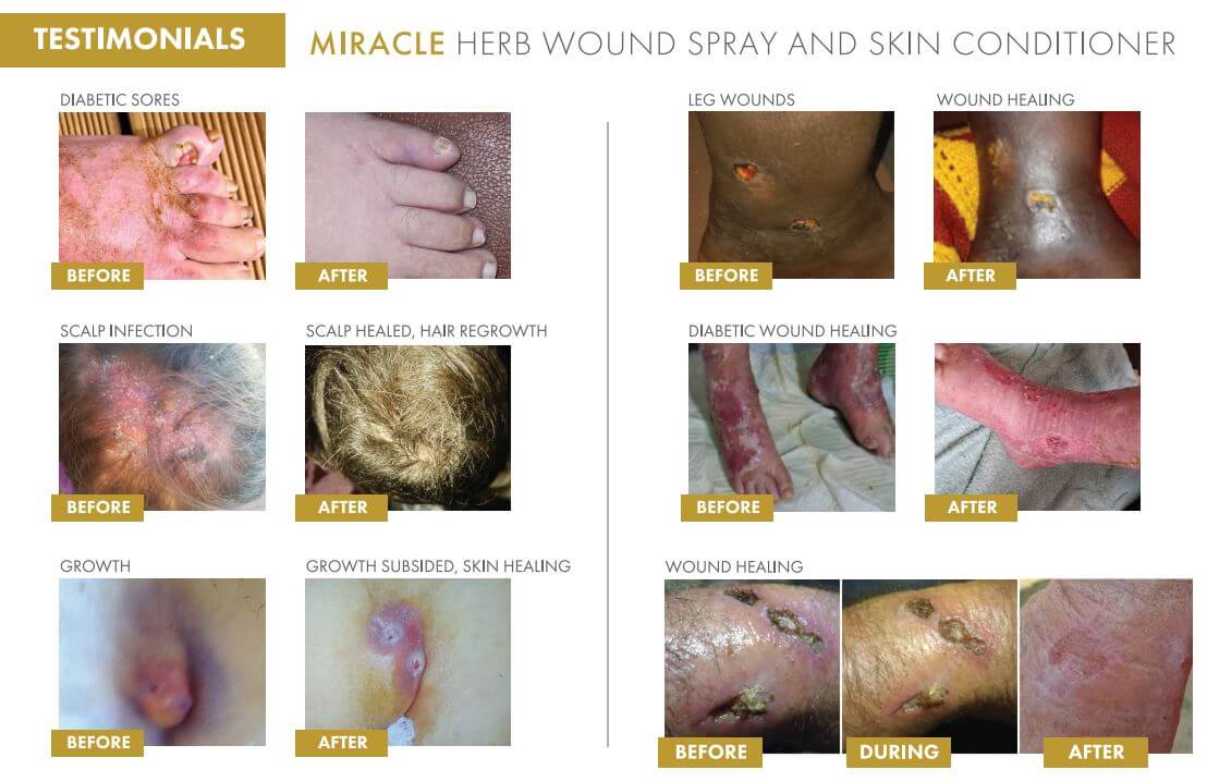 Yungskin™ Miracle Herb Wound Spray & Skin Conditioner Testimonials